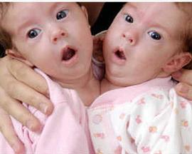 异于常人:连体人